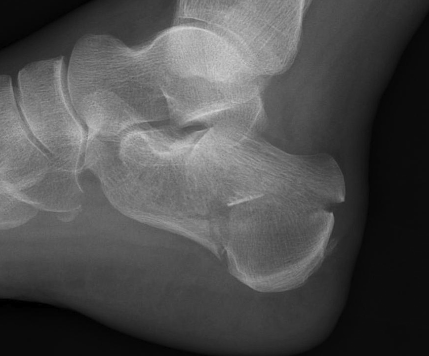 Calcaneal Fracture Lateral